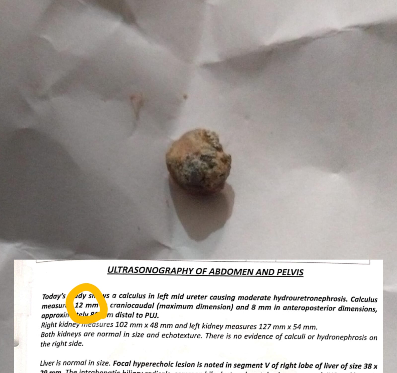 Kidney Stone (12 mm) Passed Naturally with Ayurvedic Treatment